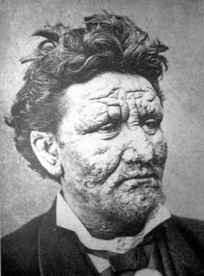 Leprosy in Minnesota | MNopedia